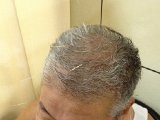 14 - Acupuncture treatment used to treat paralysis caused by a stroke.jpeg